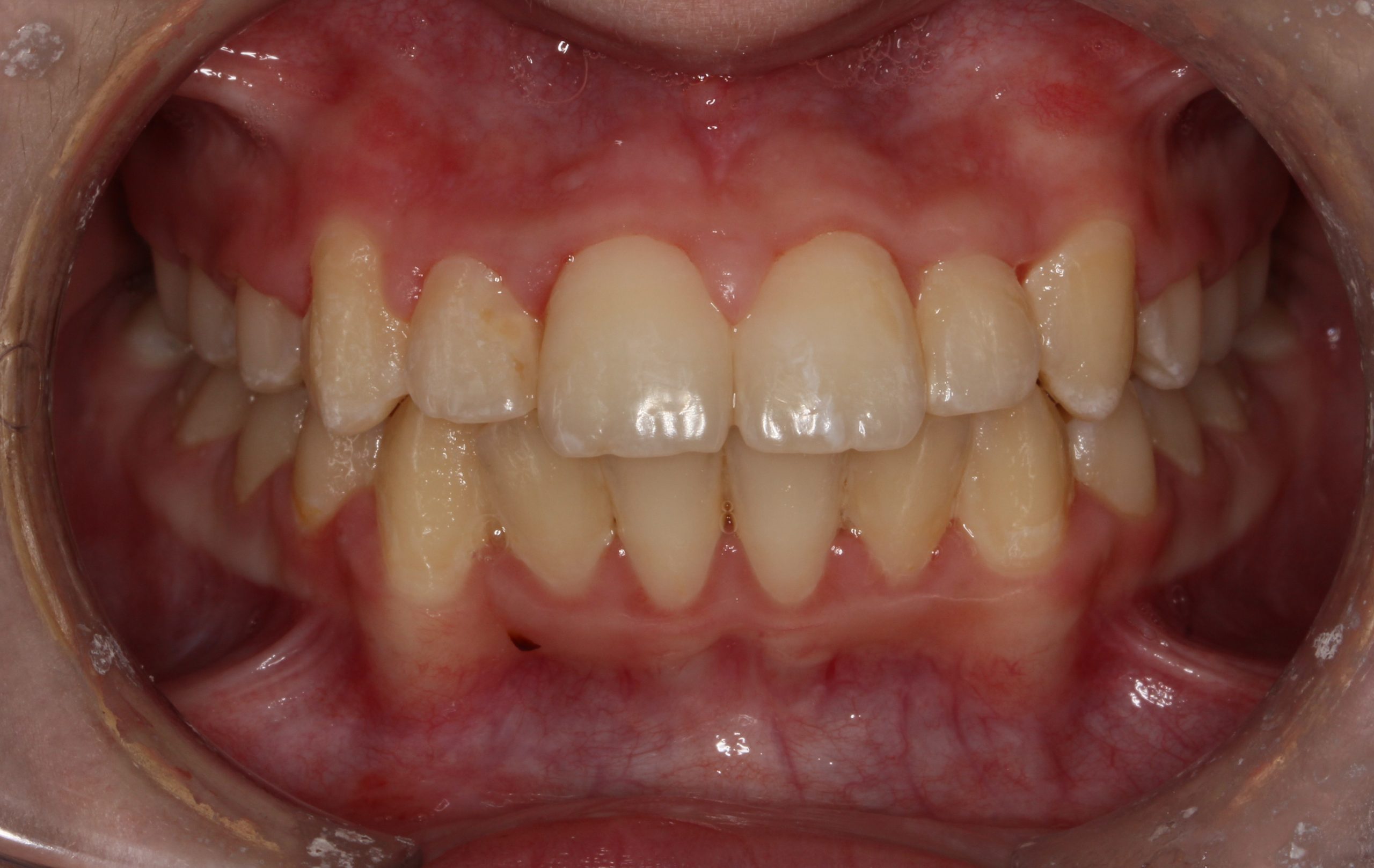 before-after